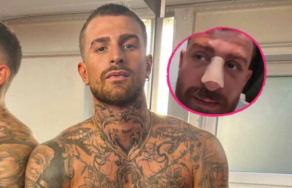Not-OP bei Gigi: Nase war schon vor Fame Fighting kaputt